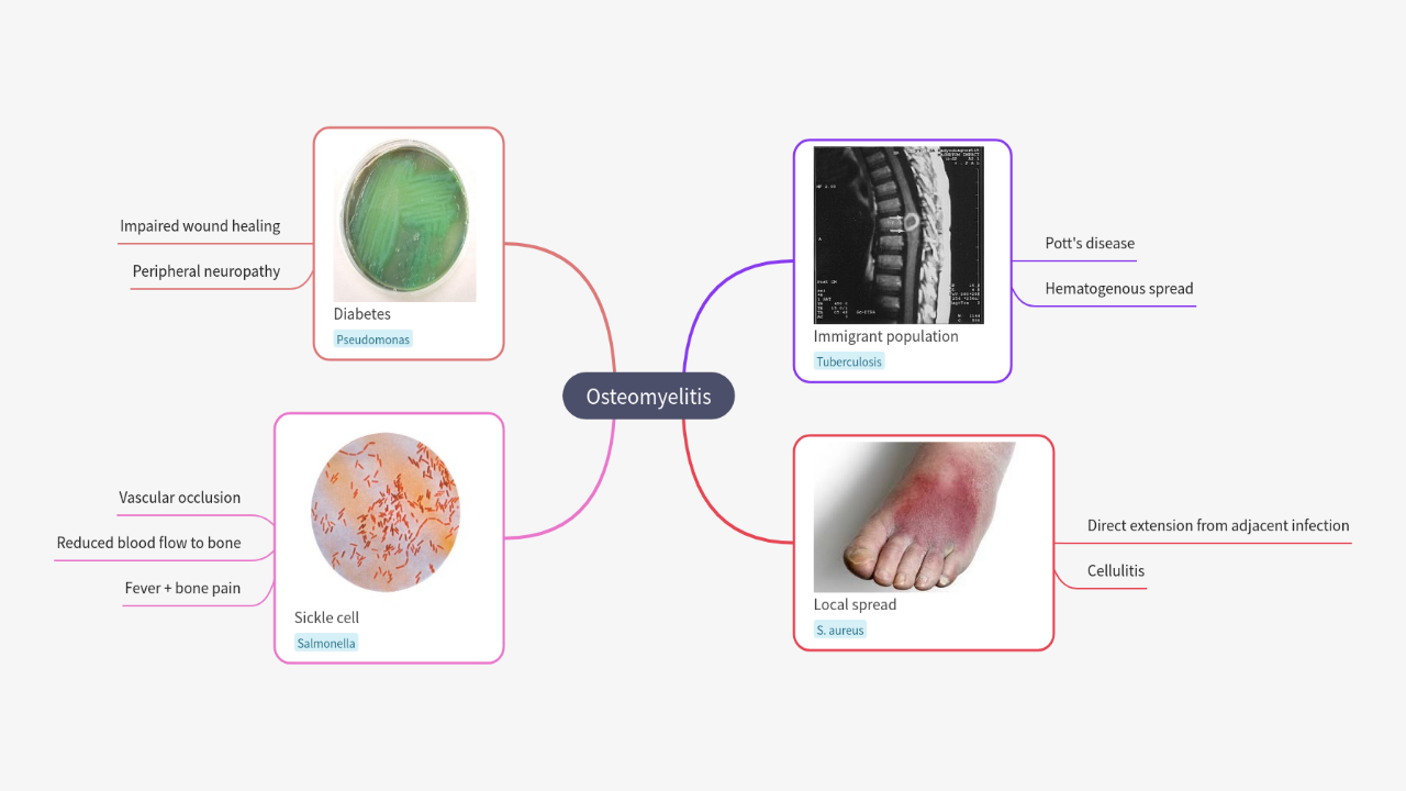 Mind Map:Osteomyelitis ...